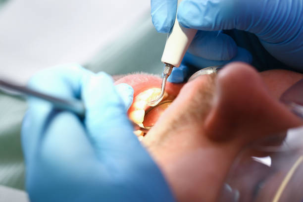 Best Emergency Root Canal Treatment in Brownsboro, TX